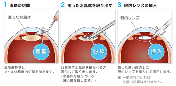 白内障手術（超音波水晶体乳化吸引術）の流れ