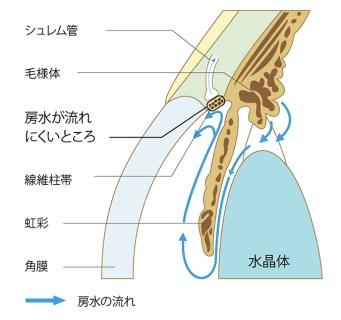 緑内障の視野障害の進行