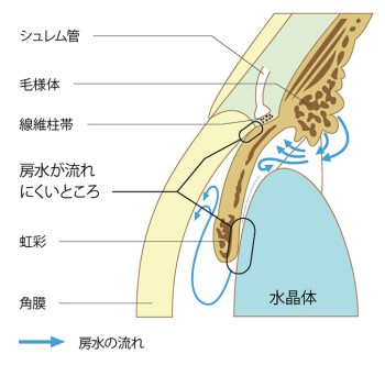 緑内障の視野障害の進行