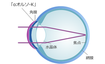 角膜の形状を正常な屈折状態に矯正します