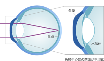 レンズを外すと視力が改善しています